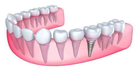 Implant Dentistry