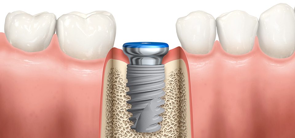 Overview of Implant Placement Overview of Implant Placement