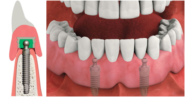 Implant Supported Overdenture Implant Supported Overdenture