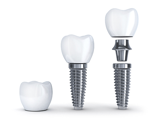 Cost of Dental Implants Cost of Dental Implants