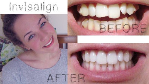 Invisalign® Testimonials Invisalign® Testimonials