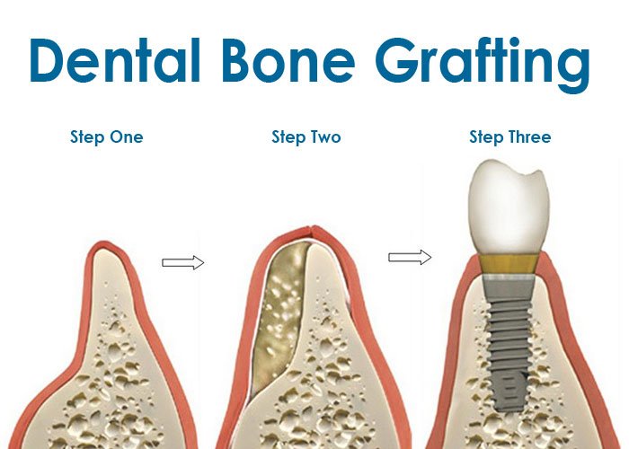 About Bone Grafting About Bone Grafting