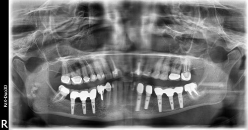 Nerve Re-positioning Nerve Re-positioning