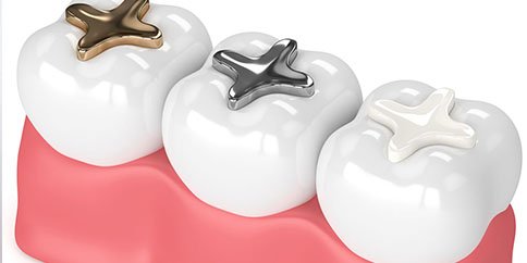 BPA-Free Restorations