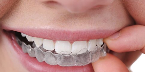 Invisalign®