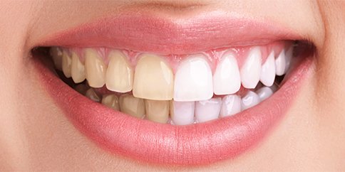Zoom® Whitening